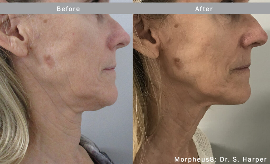 morpheus8-before-after neck